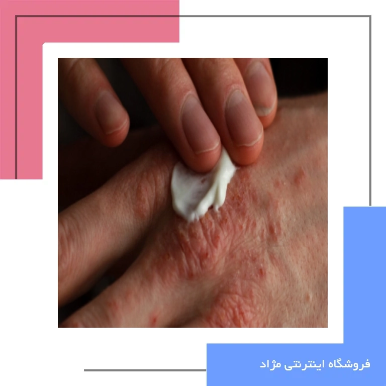 نکات مهم در مصرف و ایمنی پماد دایوبت (Dayobet)؛ راهنمای کامل برای بیماران پسوریازیس